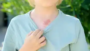 Doğum Lekeleri İçin Glikolik Asit