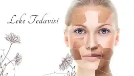 Glikolik Asit Leke Tedavisi
