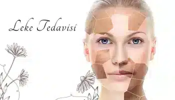 Glikolik Asit Leke Tedavisi